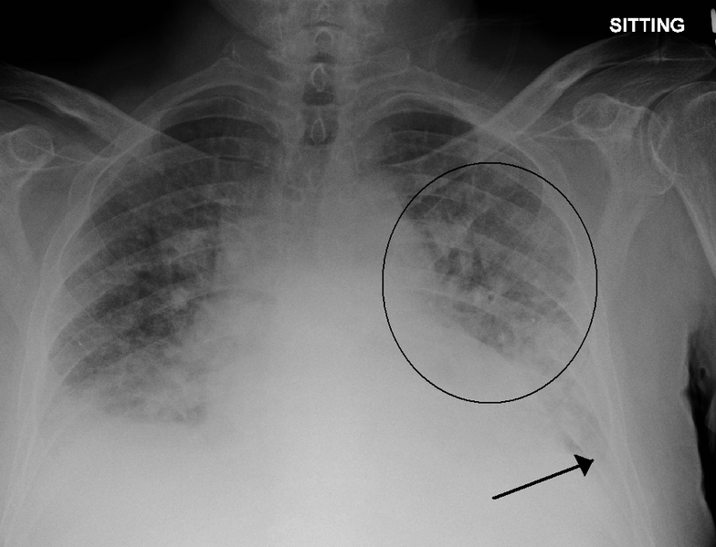 An X-ray of the chest region, with a circle and arrow identifying areas of interest on the right of the image.